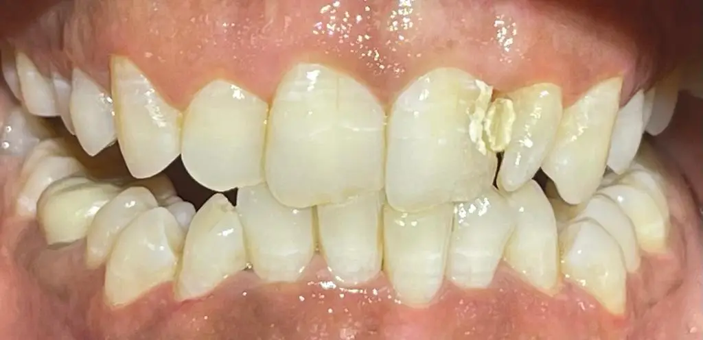 06-fillings-after