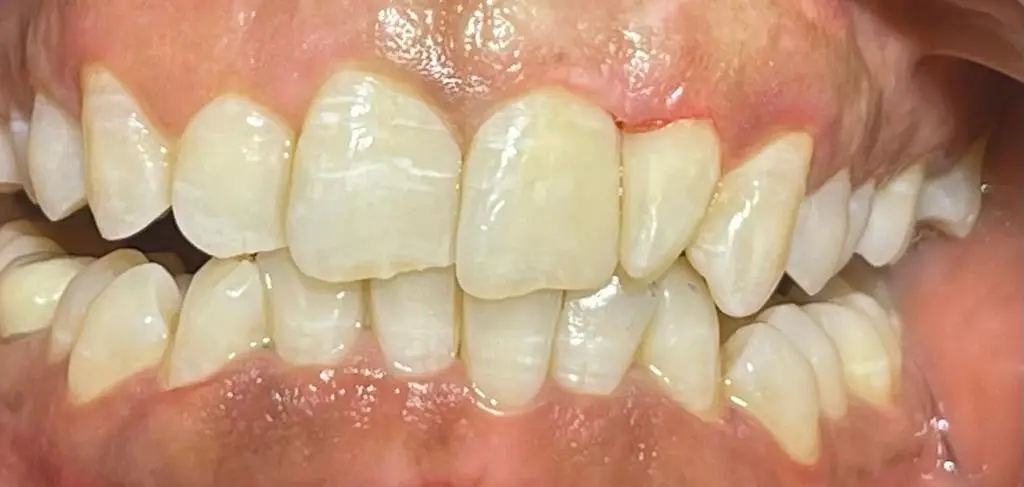 06-fillings-before
